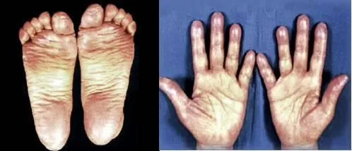 Das Hand-Fuß-Syndrom https://www.journalonko.de/aktuellview.php?id=1244